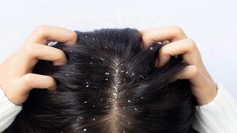 چگونه شوره موهای چرب را به کمک شامپوهای تخصصی کنترل کنیم؟