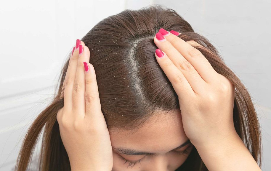 بهترین شامپو ضد قارچ پوست سر